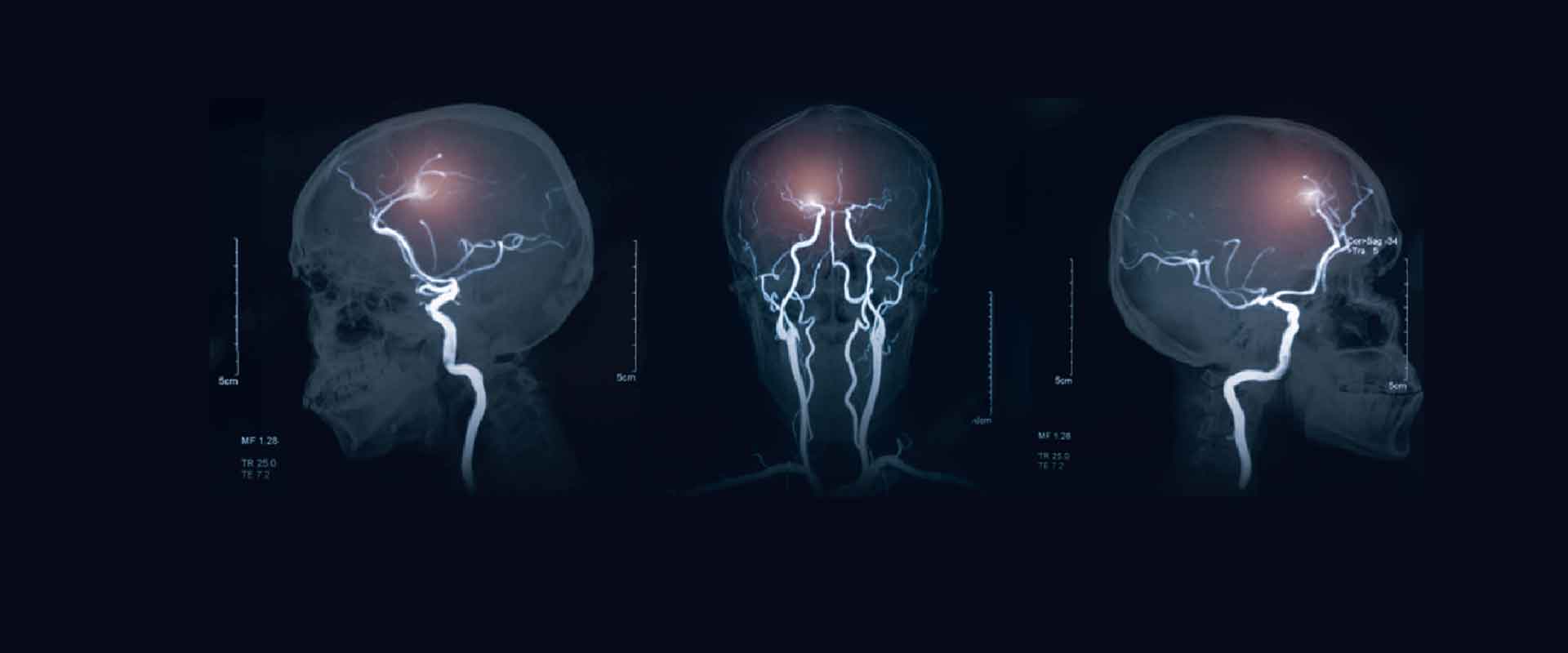 Acute Stroke Unit