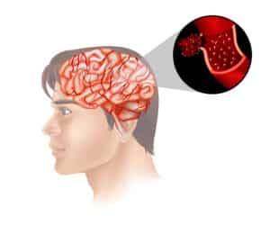 Cerebral Aneurysm Treatment